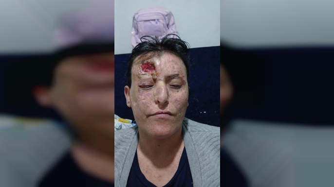 DİYARBAKIR’DA BİR ANNE YAŞAM MÜCADELESİ VERİYOR: “TEK İSTEĞİM ÇOCUKLARIM İÇİN YAŞAYABİLMEK”